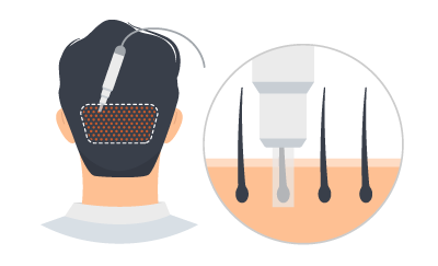 医師が目視で移植に適した毛髪を選び、極細のパンチクラフトで毛包を採取します。