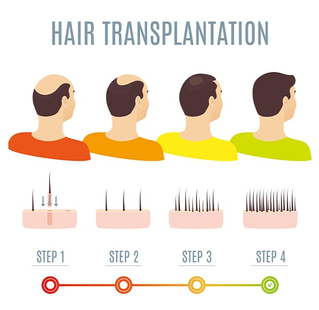自毛植毛の種類